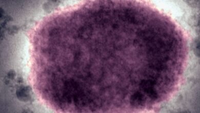 US Reverts to Controversial Disease Name After Global Rebrand
