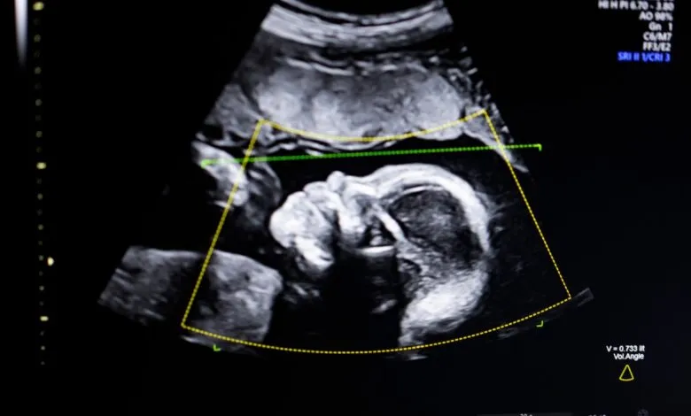 Ultrasound image shows a developing fetus in the womb, profile view.