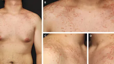 Four images showing skin condition on a person's chest and neck.