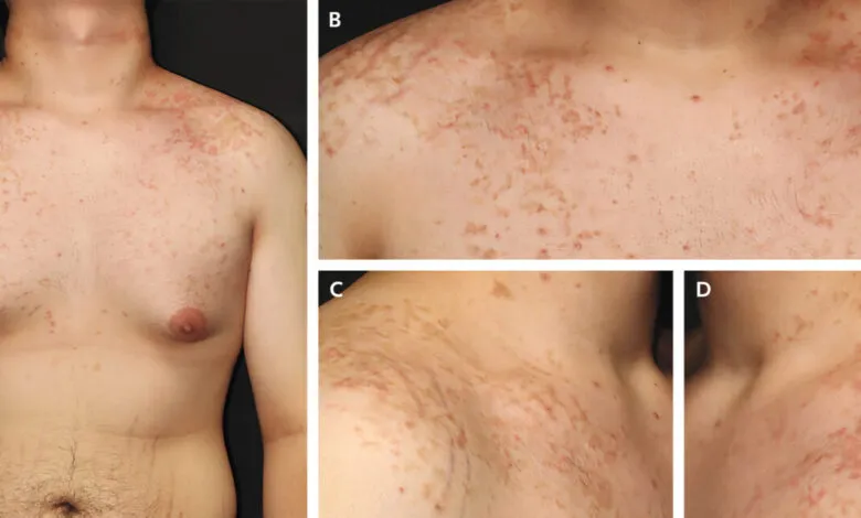 Four images showing skin condition on a person's chest and neck.