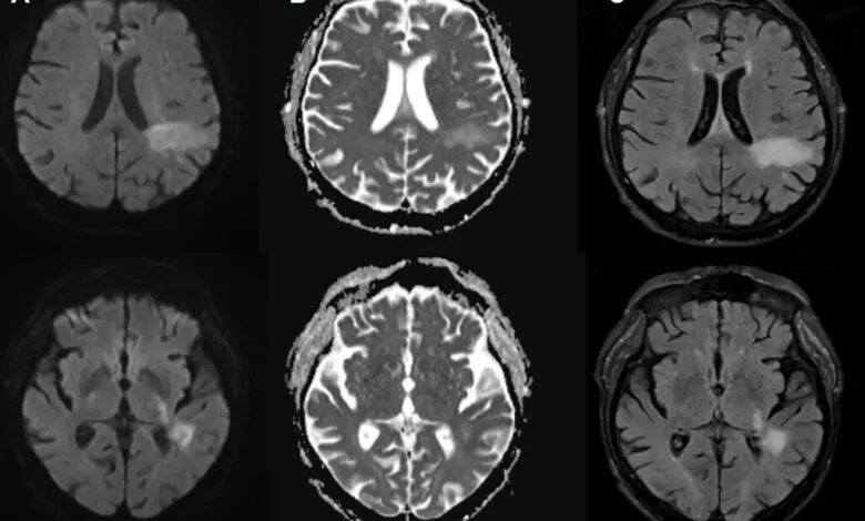 Brain MRI scans showing lesions in the right hemisphere, different imaging modalities.