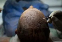 Close-up of patient's head during hair transplant procedure.