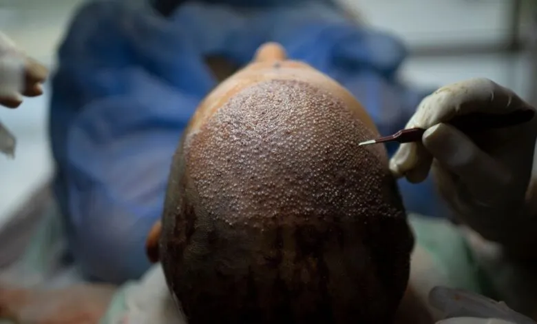 Close-up of patient's head during hair transplant procedure.