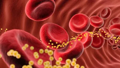 3D rendering of red blood cells with cholesterol deposits in a blood vessel.