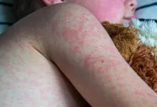 Child's arm and face covered in a red rash, resting with a stuffed animal.