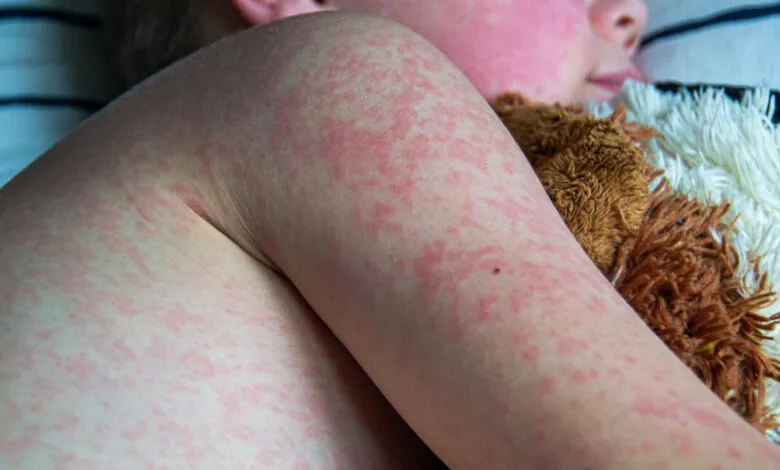 Child's arm and face covered in a red rash, resting with a stuffed animal.