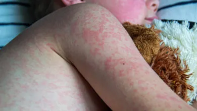 Texas measles outbreak analysis reveals virus's deadly risks