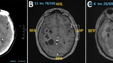 Man's Brain Tumor Symptoms Were Actually Caused by Worms